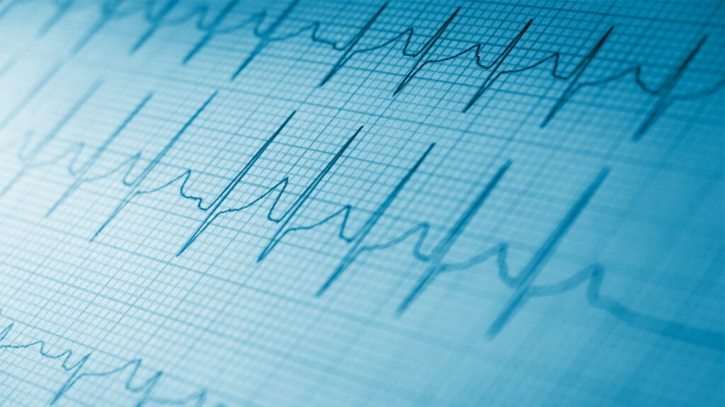 PSVT heart: Symptoms, causes, treatment, and more