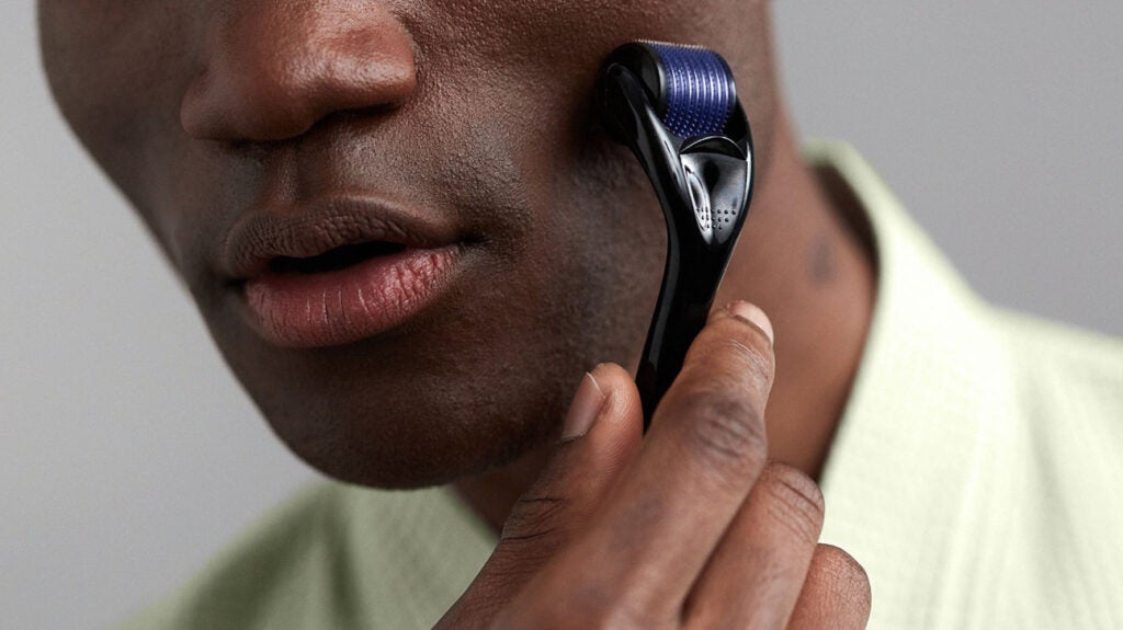 Acne scars Microneedling may be better than AHA peels for dark skin