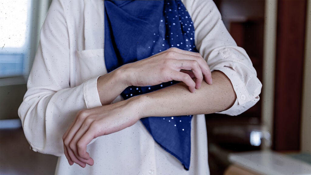 Acute eczema Symptoms, causes, treatment, and more