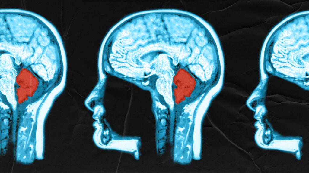 https://post.medicalnewstoday.com/wp-content/uploads/sites/3/2022/08/cerebellum-brain-MRI-header-1-1024x575.jpg