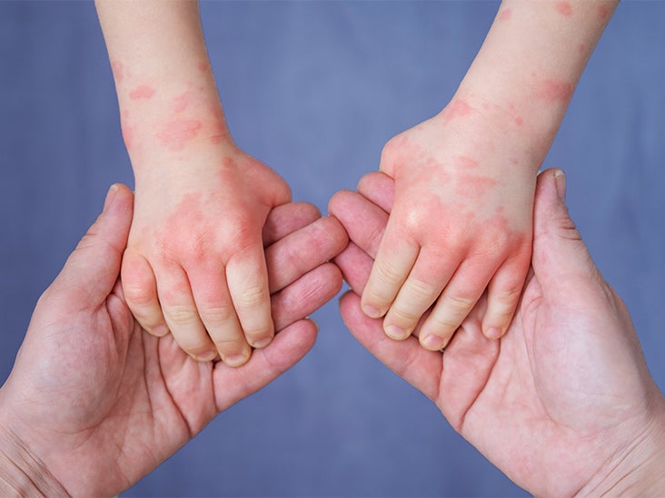 Can Eczema Occur In One Spot