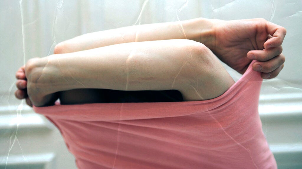 Psoriatic arthritis elbow Pictures, overview, and more