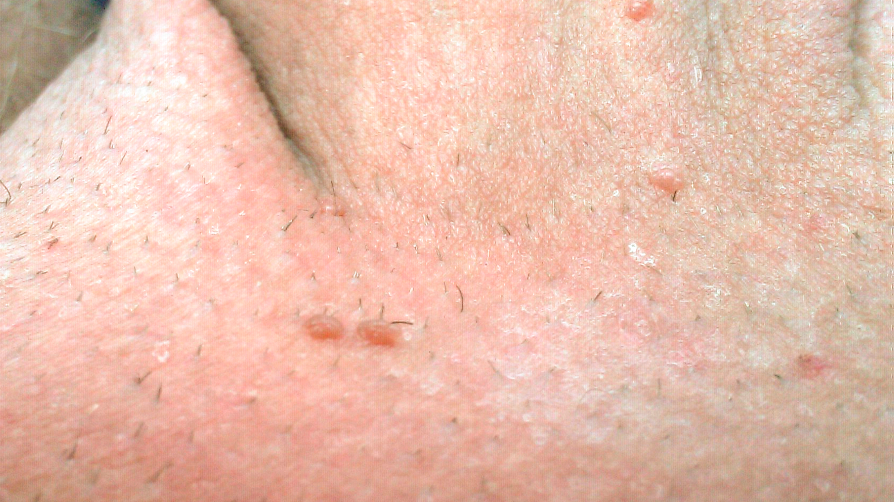 Immunitet Knogle Forsvinde Genital warts: Treatment, causes, and symptoms