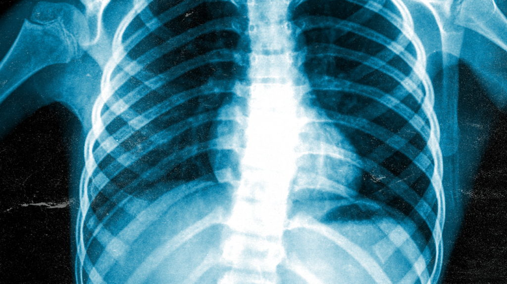 Normal Chest Anatomy Medical Exhibit