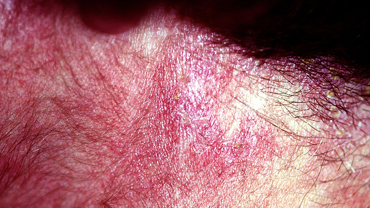myositis skin rash