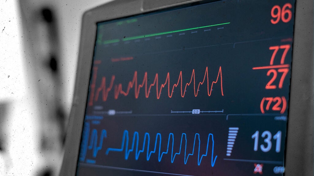 Intra aortic Balloon Pump Benefits Risks What To Expect