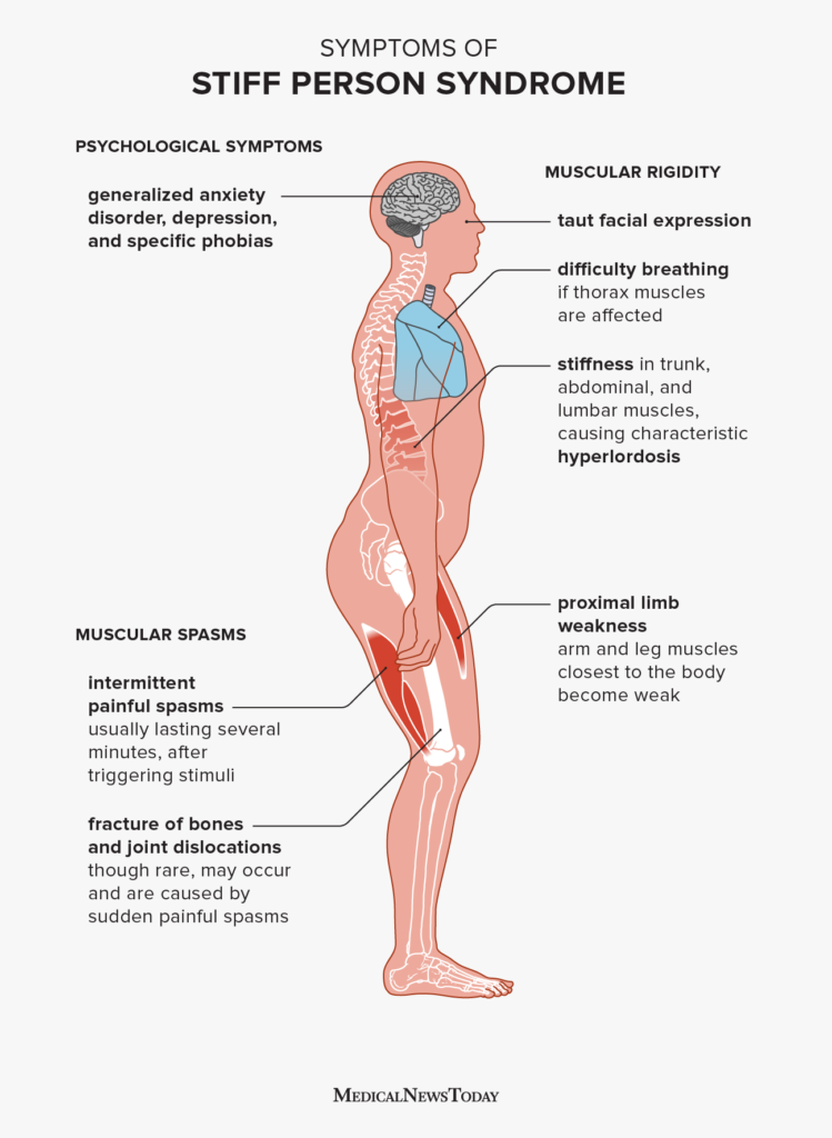 Stiff Person Syndrome Treatment Symptoms And Outlook