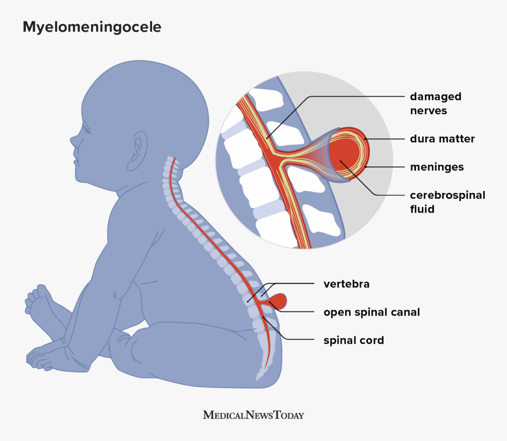 Myelomeningocele Definition Symptoms And Treatment 7295