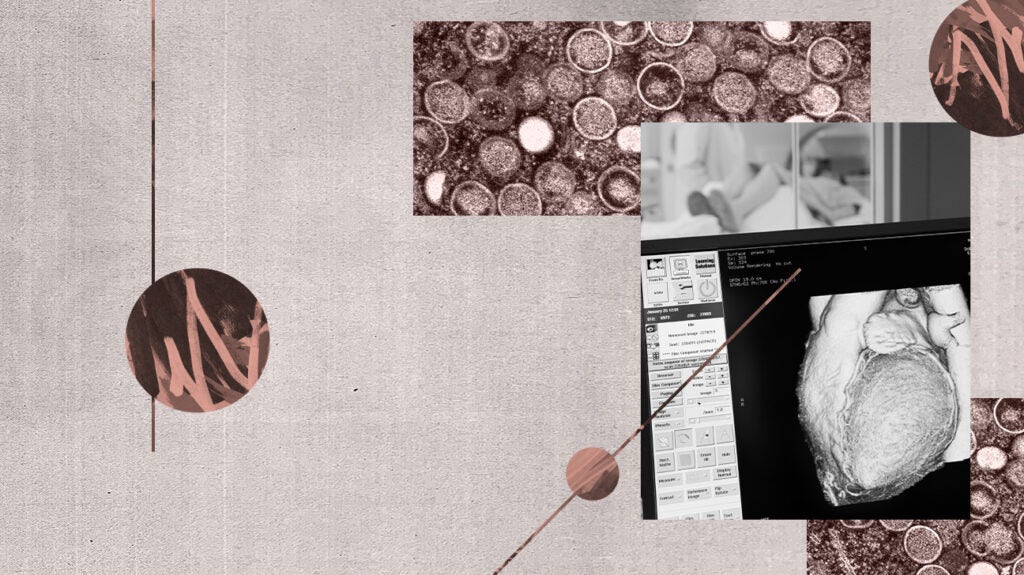 Can monkeypox cause heart problems? One case study says it may | Originol