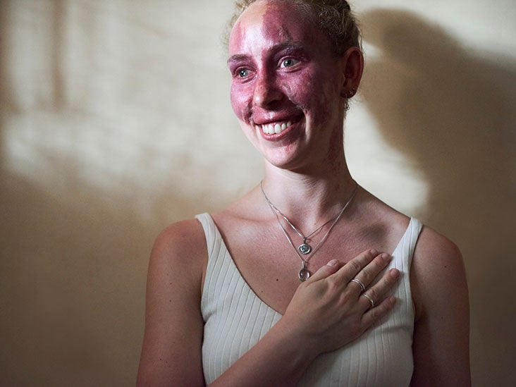 What To Know About Port Wine Stain Birthmarks
