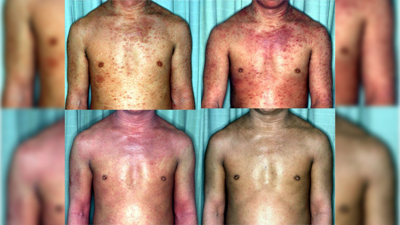 What Is Topical Steroid Withdrawal The Eargazm