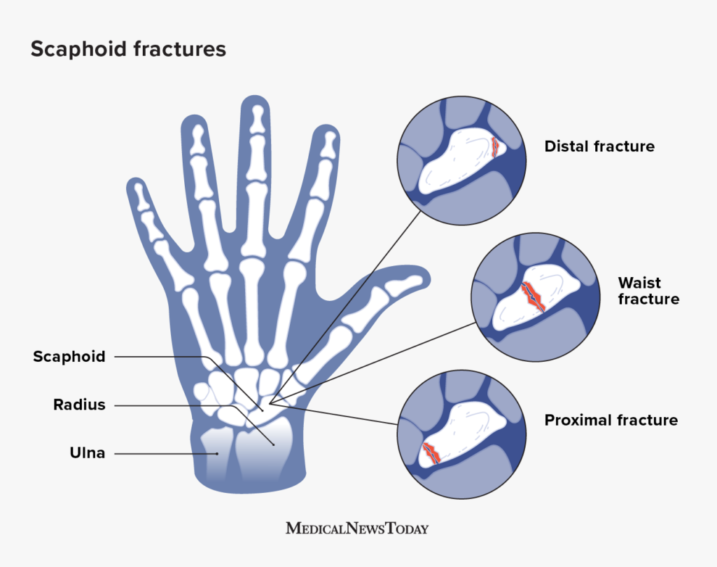 Scaphoid fracture Treatment, symptoms, and recovery