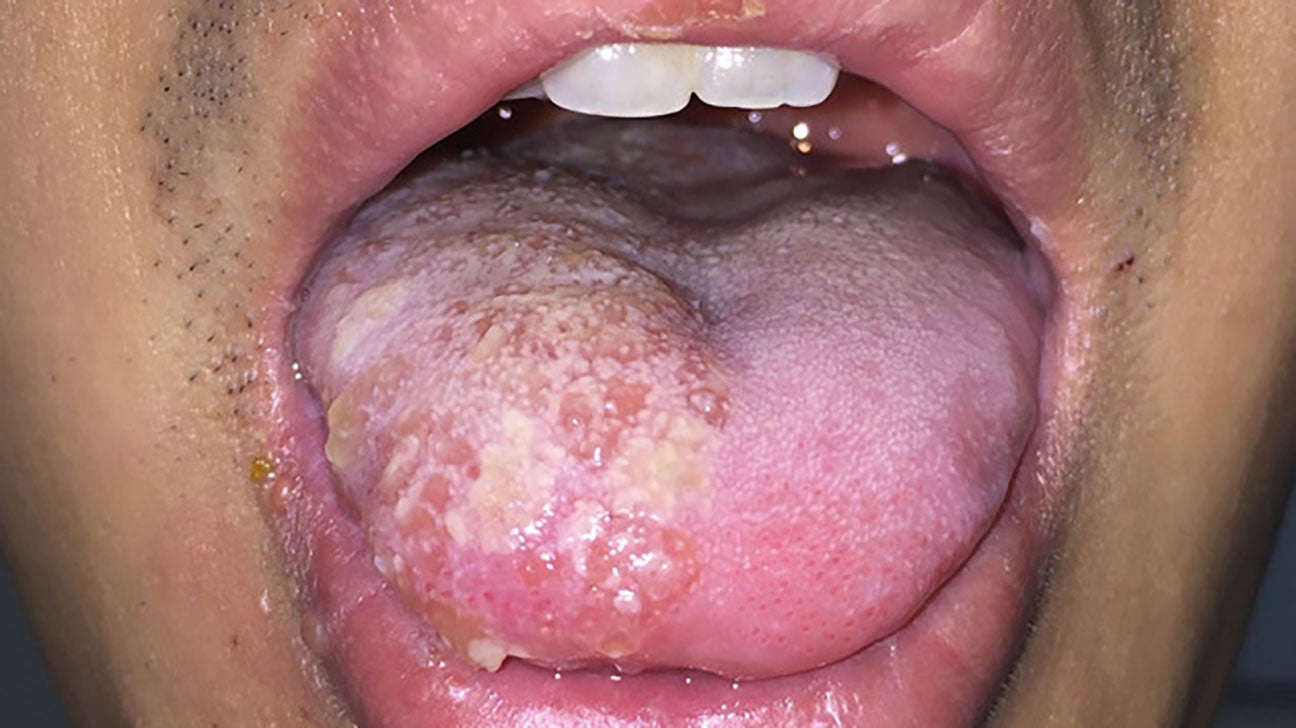 herpes 2 in the mouth