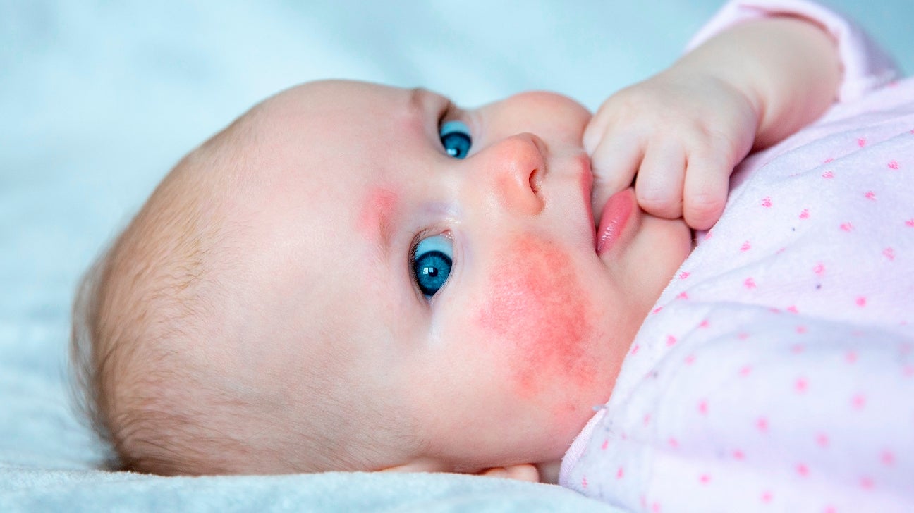 baby allergic reaction rash on face