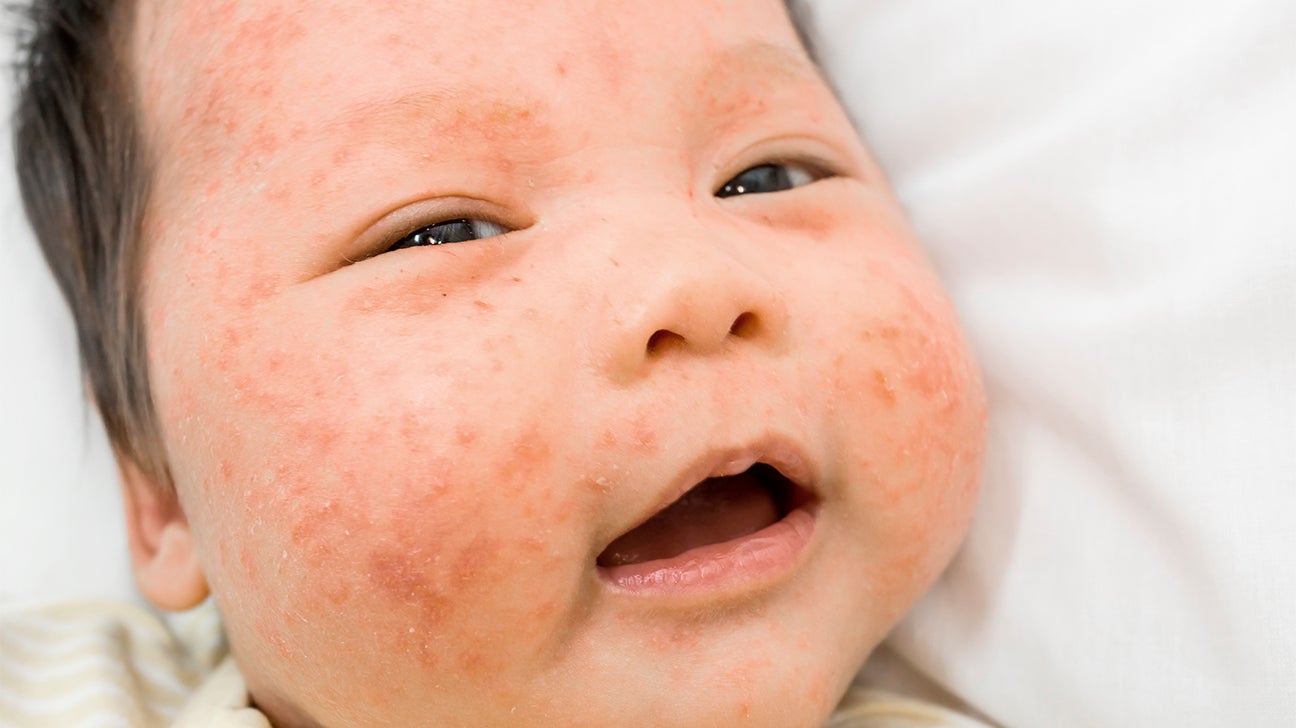 baby allergic reaction to milk