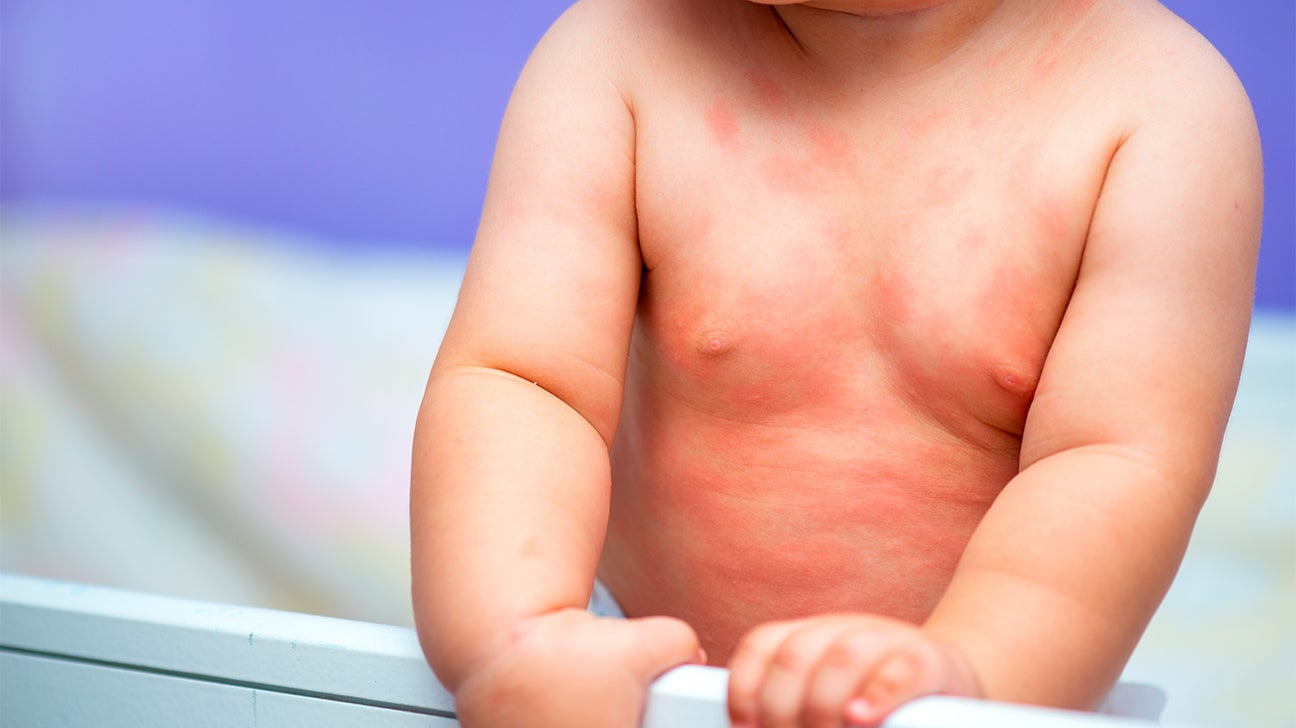 Dairy Allergy Rash Adults