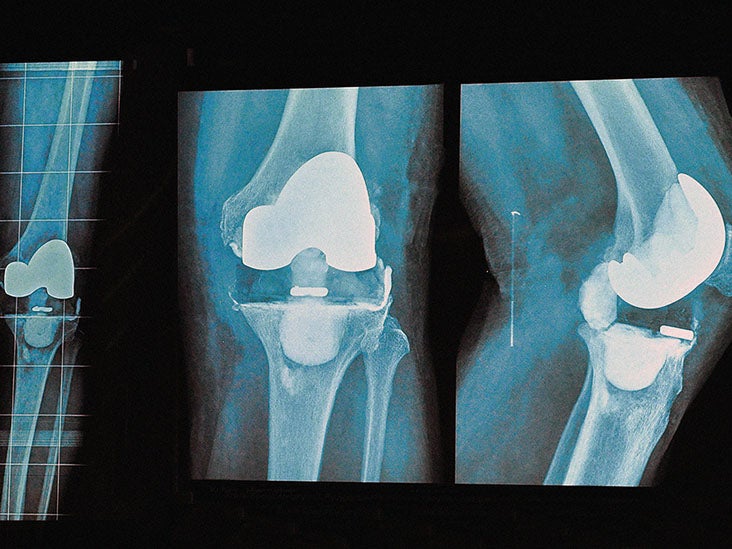 Can You Still Have Arthritis After Knee Replacement 