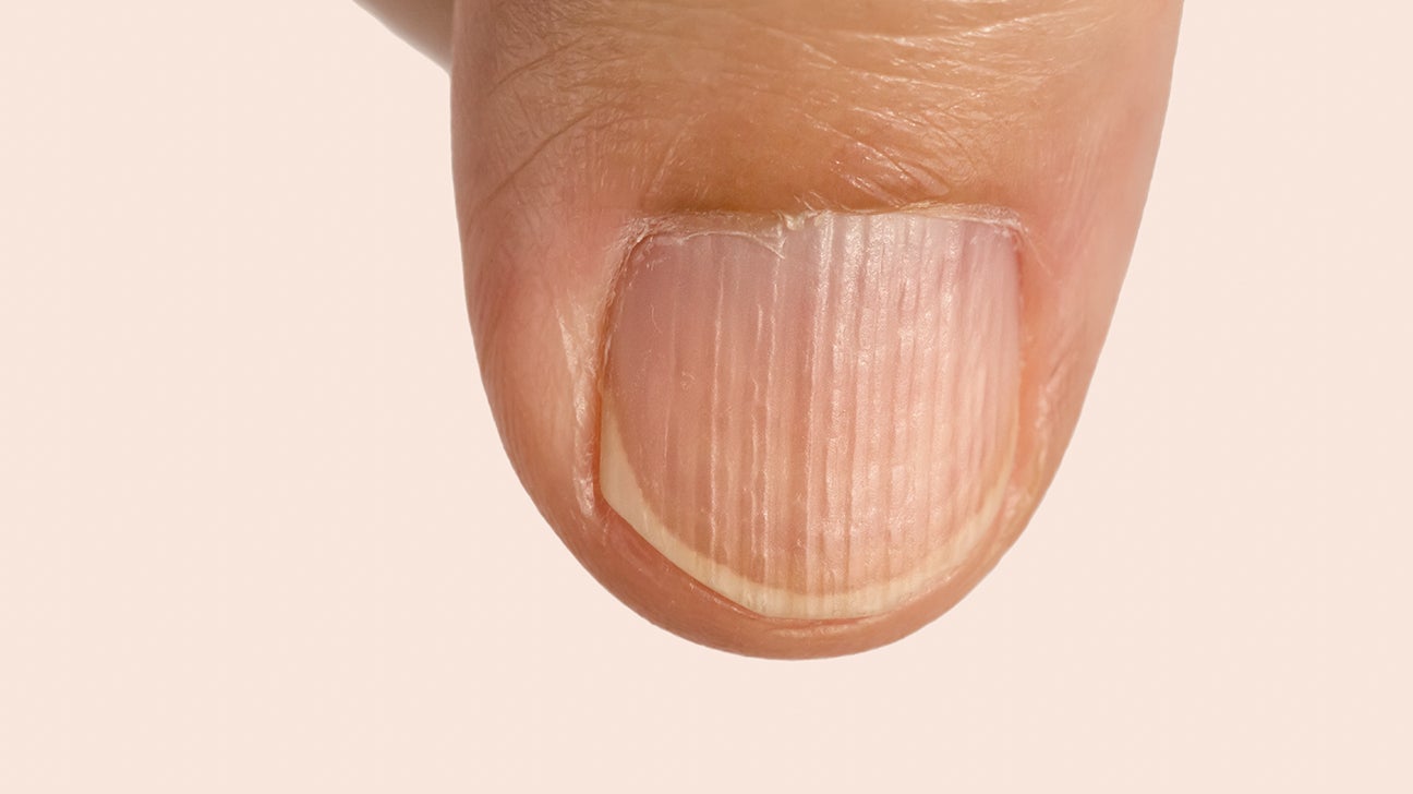 Psoriatic arthritis and nails: Changes and treatment