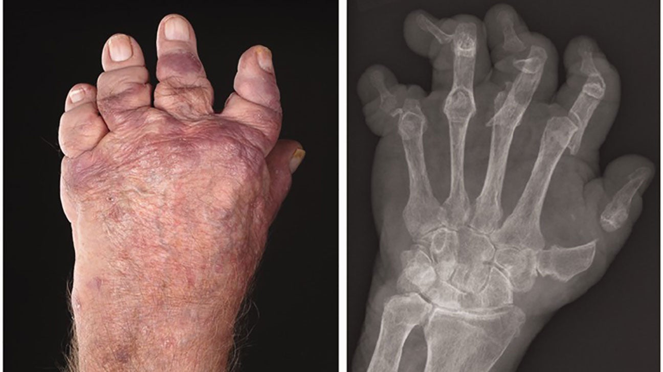 Psoriasis Hands Xray