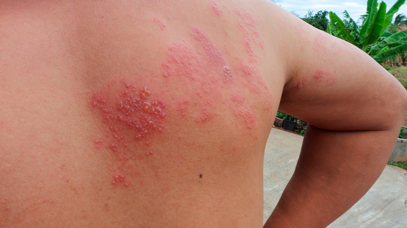 rash on back