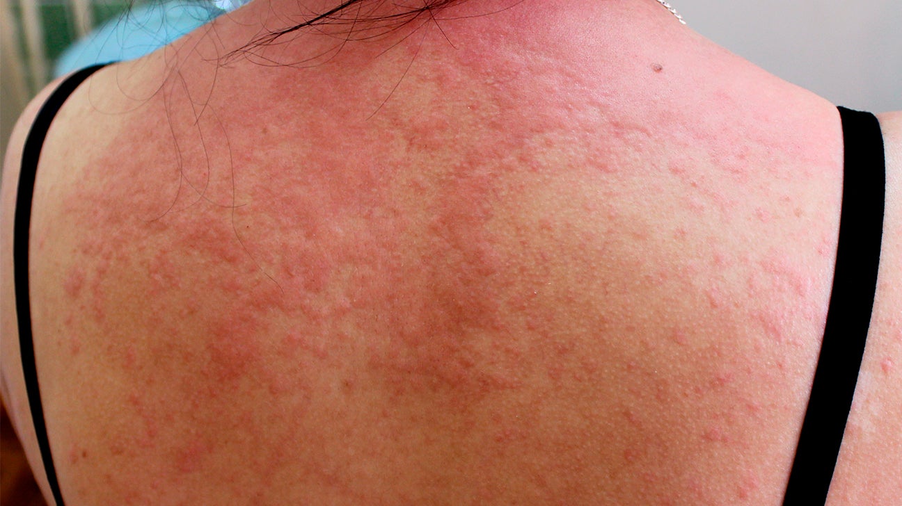 rashes-on-back