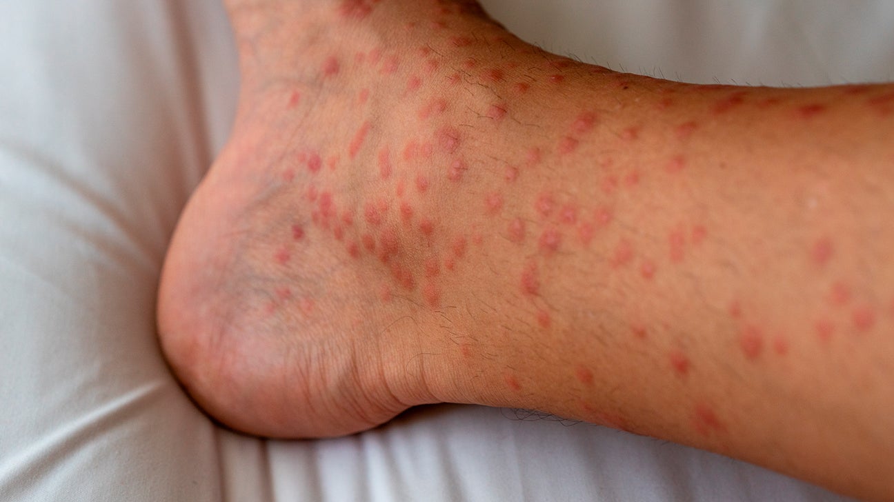 Skin rash: Causes, 71 pictures of symptoms, and treatments