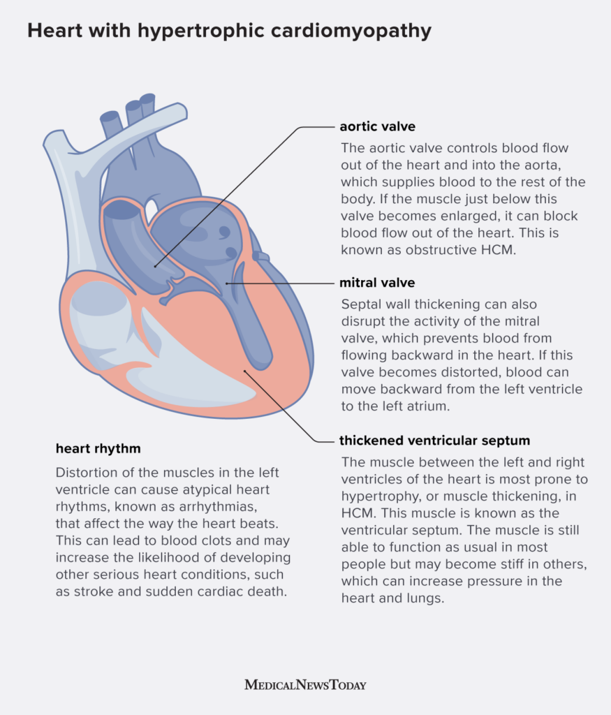 How does hypertrophic cardiomyopathy affect the heart?