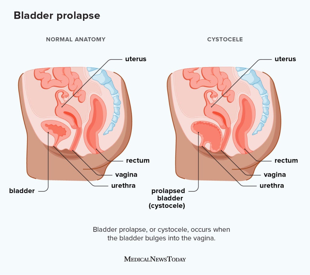 Bladder prolapse: Symptoms, stages, and more
