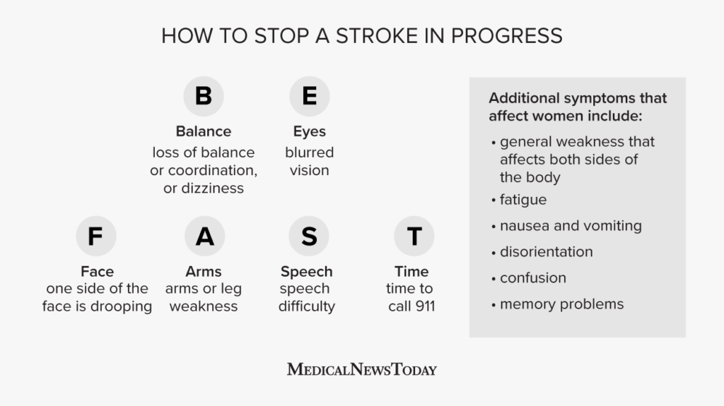 Stroke symptoms in females: What they are and next steps