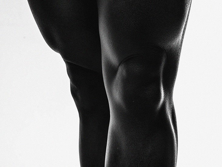 knee-arthritis-corticosteroid-injections-may-worsen-progression
