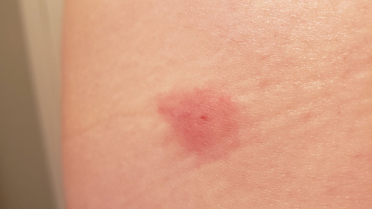 Horsefly bites: Identification and treatment