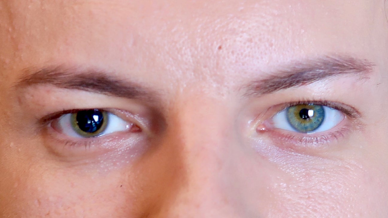 Левый глаз темнее правого. Анизокория. Бернара-горнера (птоз, миоз, энофтальм).. Гетерохромия и анизокория.