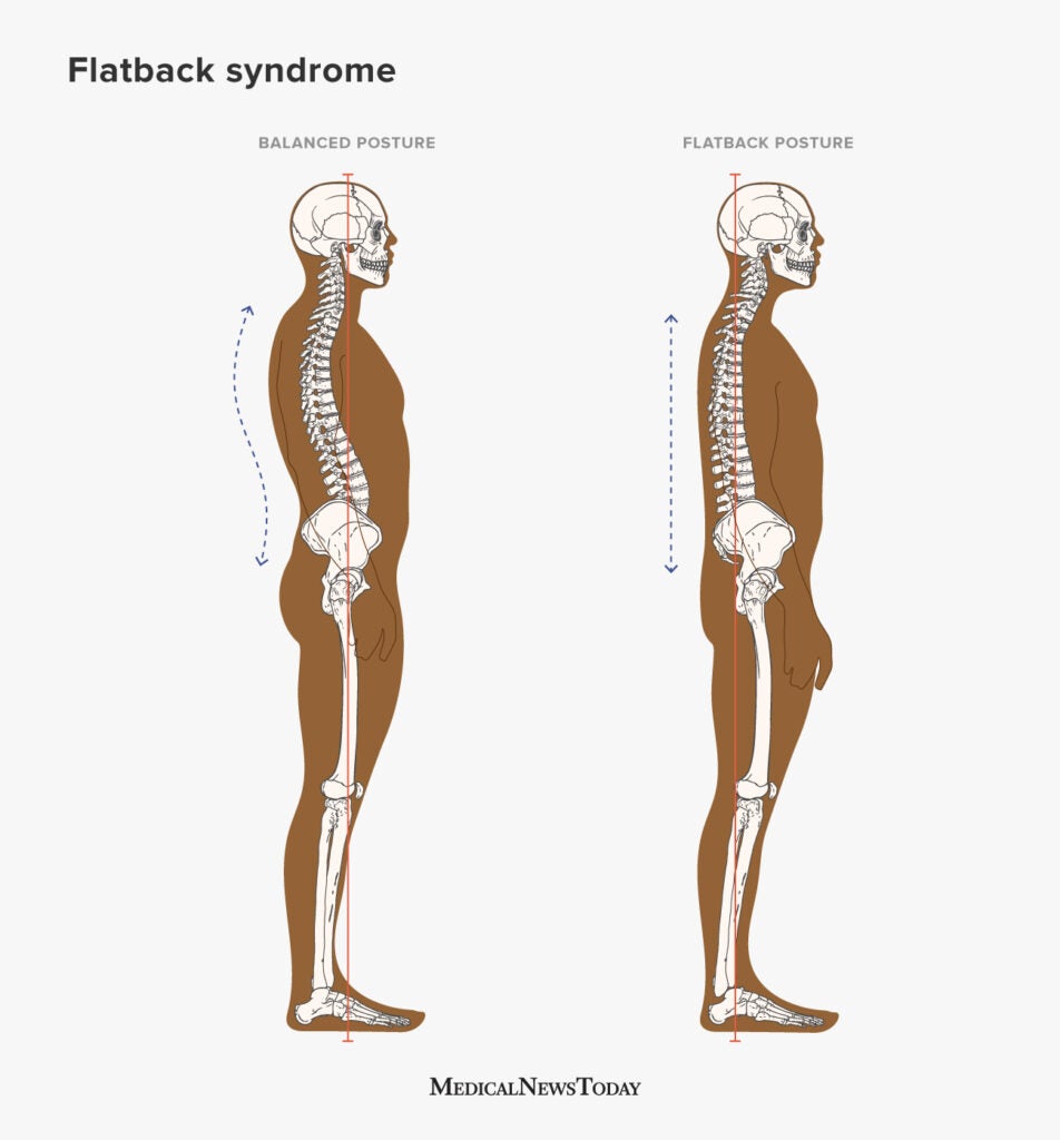 Lumbar Lordosis Exercises: How to Flatten your Spine
