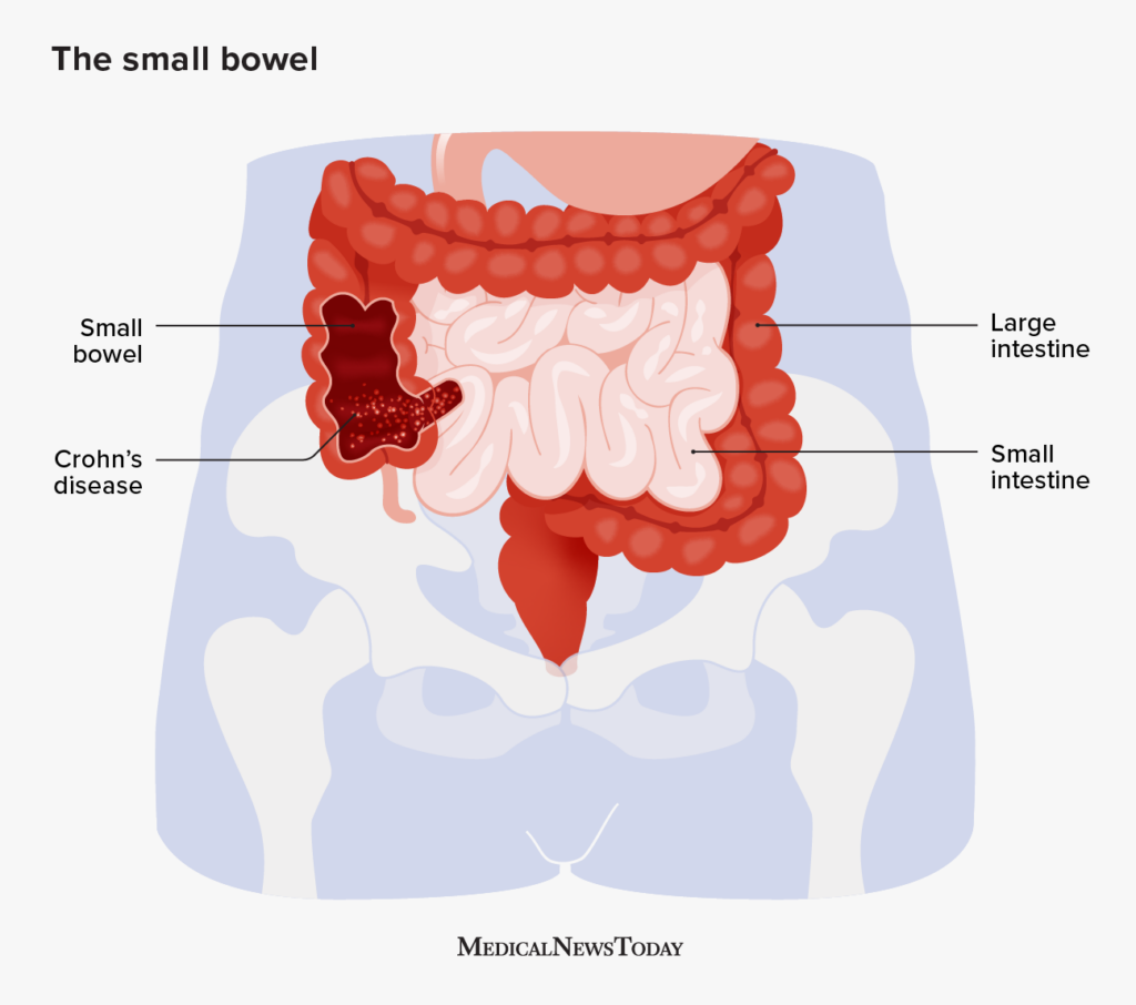 Crohns Disease In The Small Bowel Symptoms And More 2006