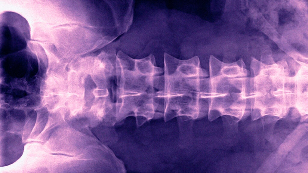 Spinal compression fracture, Radiology Reference Article