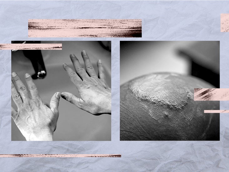 Eczema Common areas and more