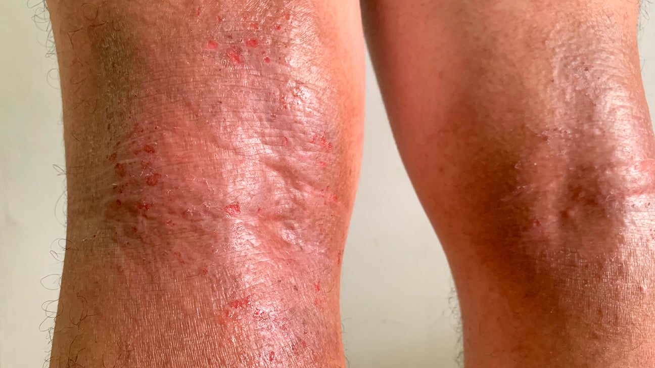 Heat Rash Knees