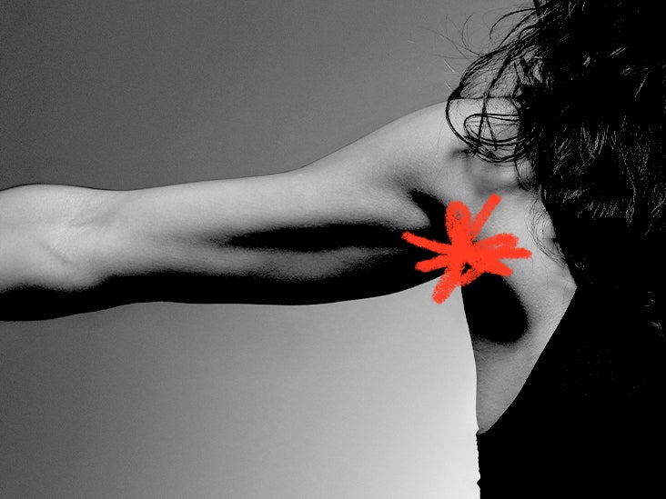 Mild hidradenitis suppurativa: Symptoms and treatment