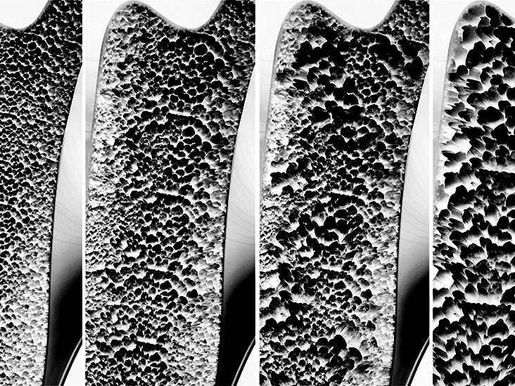 Stages of osteoporosis what are they 