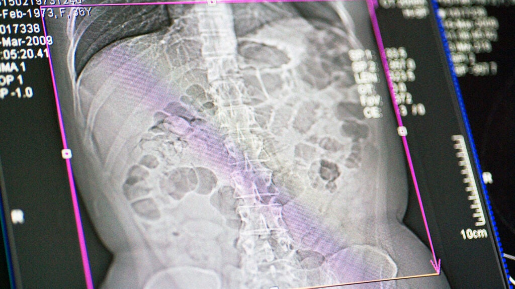 Ankylosing spondylitis back pain Treatments and tips