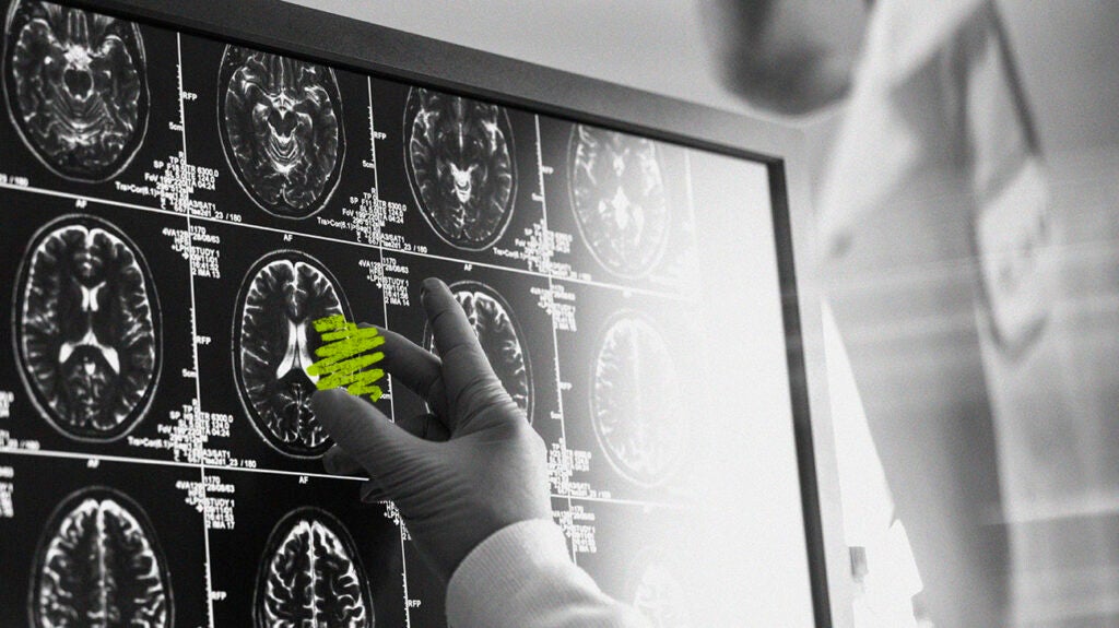 how-long-will-a-stroke-show-up-on-an-mri-or-ct-scan