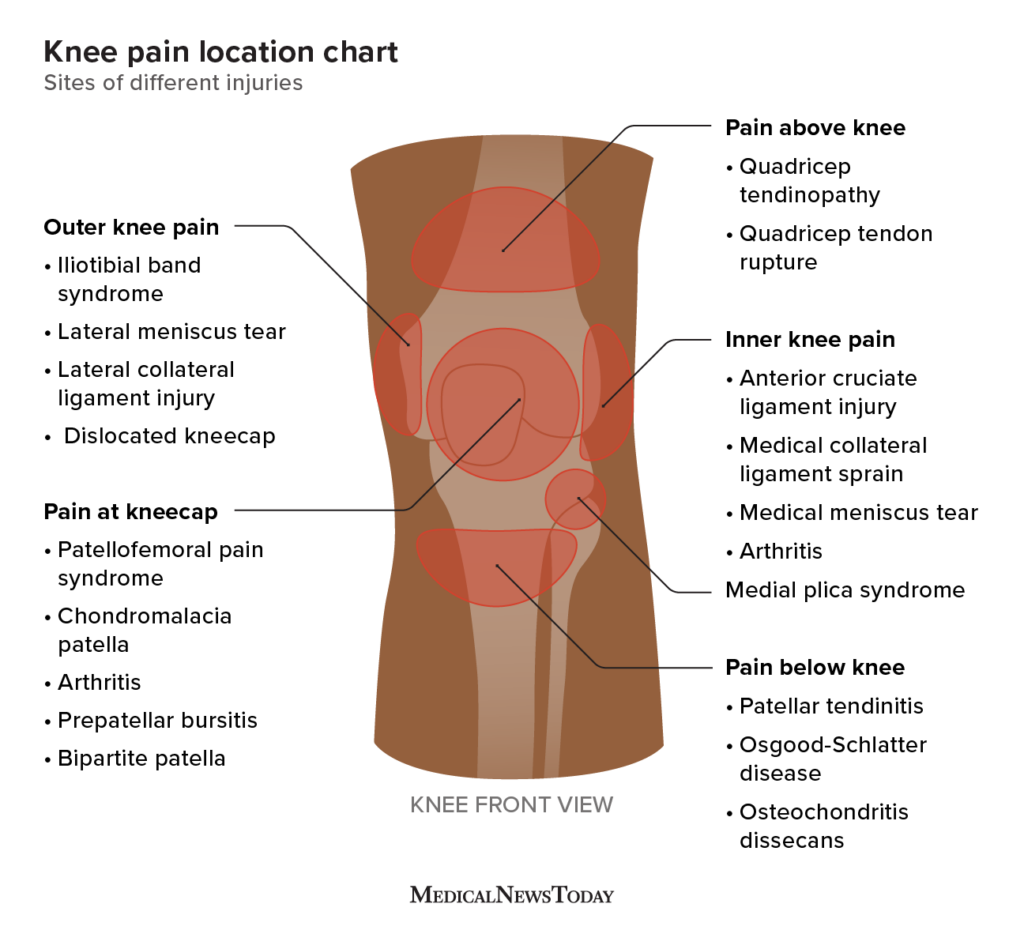 Knee pain location chart Sites of different injuries