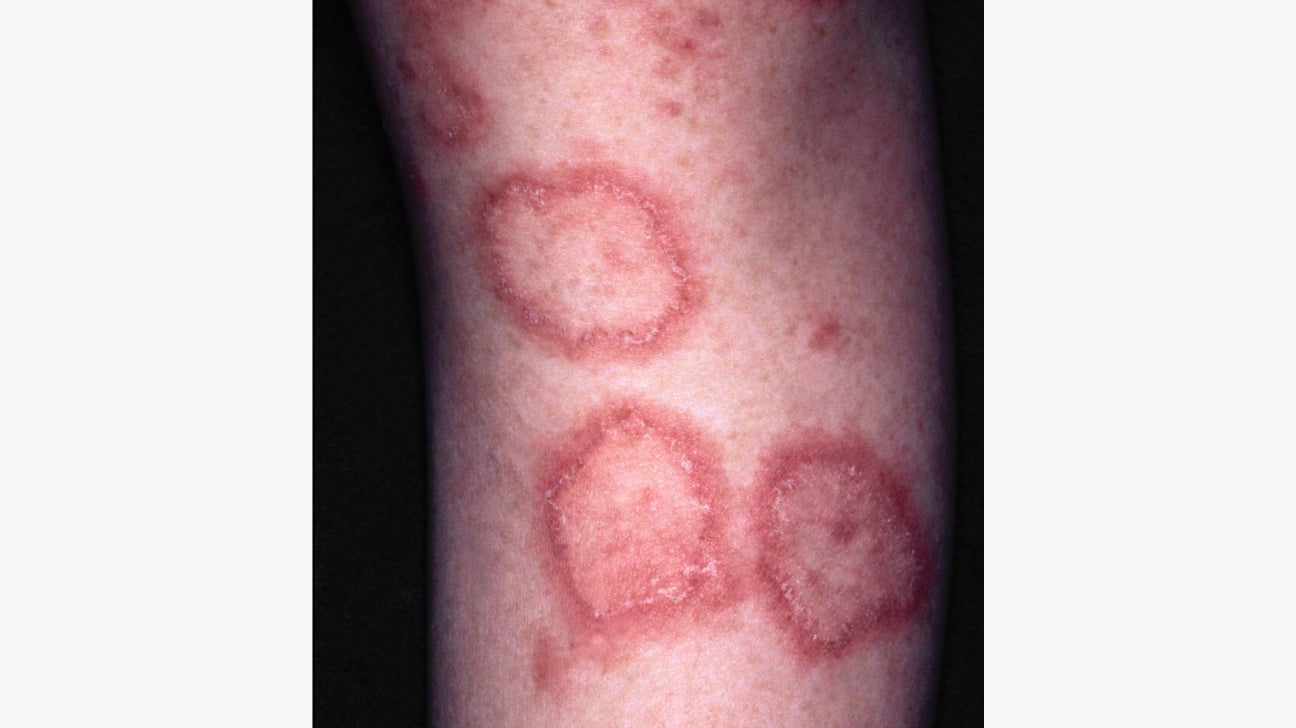 discoid lupus scars