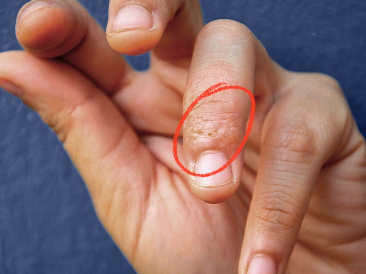 eczema fingertips treatment
