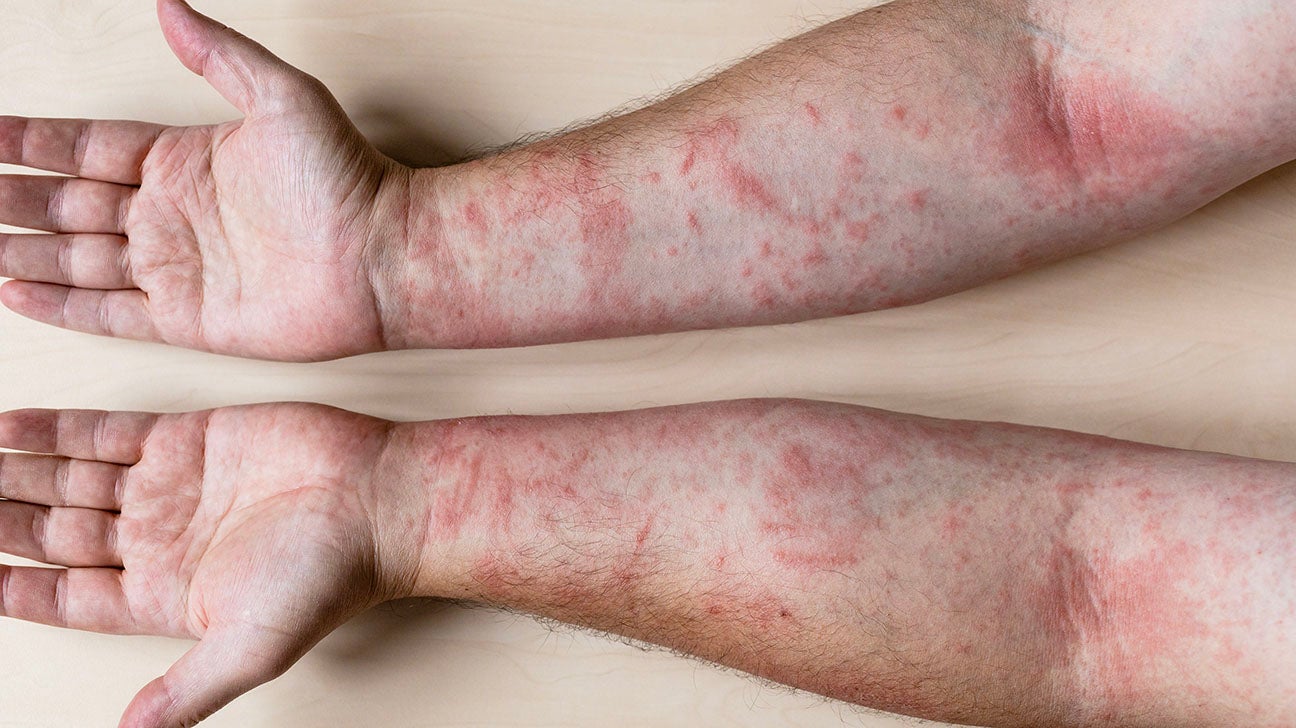 allergic reaction rash on legs
