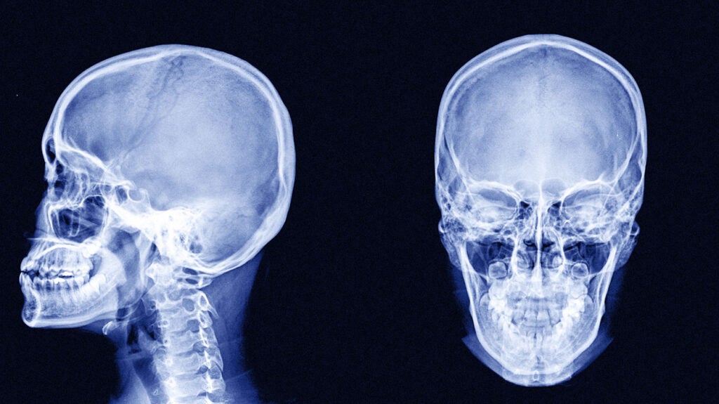 Bone cancer on the skull: Symptoms and more