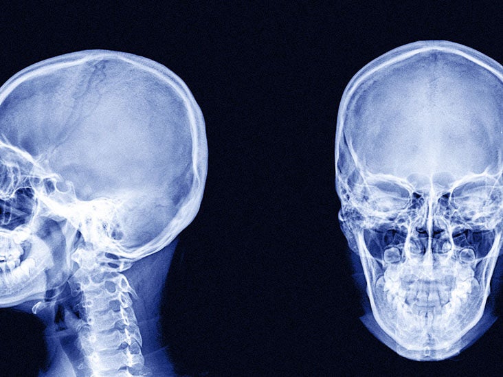Bone cancer on the skull: Symptoms and more