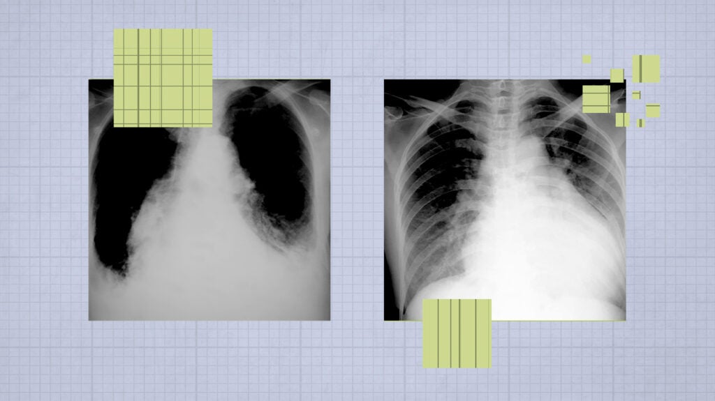 Heart failure: How does it appear on a chest X-ray?