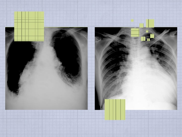 Heart Failure How Does It Appear On A Chest X ray 