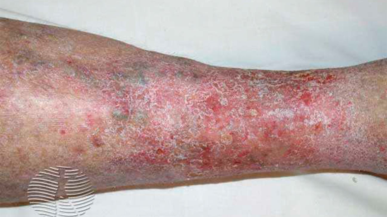 Eczema on the shin: Symptoms, causes, and treatments